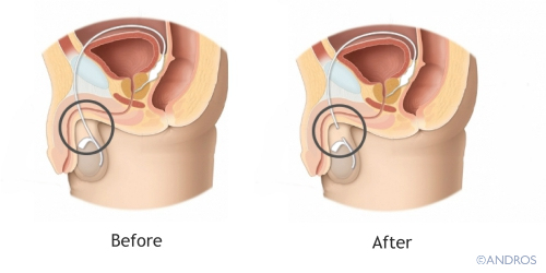 Male Sterilisation sperm tubes before and after vasectomy